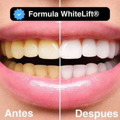 UltraWhite Carbon - Blanqueador Dental